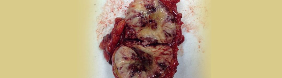 Cáncer de mama palpable