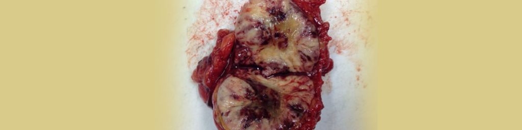 Cáncer de mama palpable