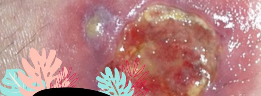 Linfogranuloma venereo