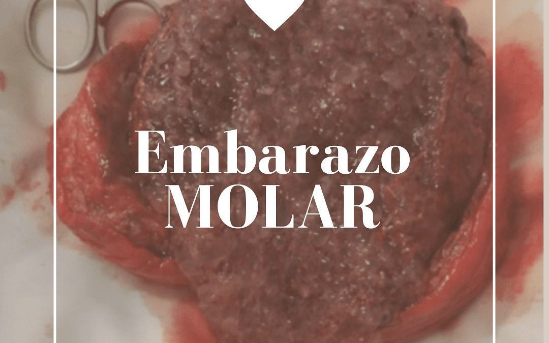 Un embarazo molar