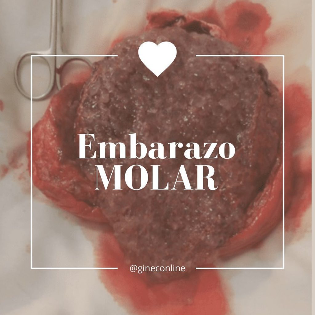Un embarazo molar